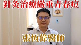 五臟平衡針法臨床實戰  青春痘的針灸治療