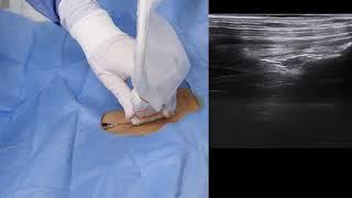 Linear Probe Right Sided Subclavian Central Venous Catheterisation