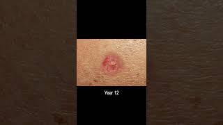 Basal Cell Carcinoma Skin Cancer Development Time Lapse (Normal to Cancer Over 25 Years)