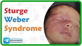 Sturge Weber Syndrome: Genetics, Clinical manifestations, Diagnosis, Treatment: USMLE Step 1