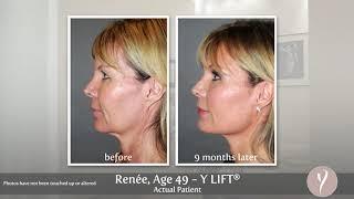 Y LIFT Non Surgical Facial Contouring