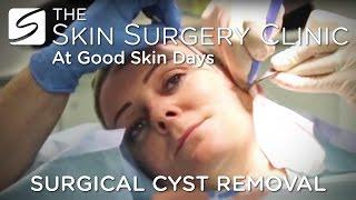 Cyst Removal | Watch the Procedure