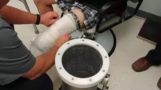 Union Orthotics & Prosthetics Co.: Using The Romedis Symphonie Prosthetic Socket Casting System