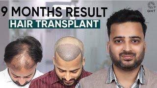 Hair Transplant in Hyderabad | Best Results & Cost of Hair Transplant in Hyderabad