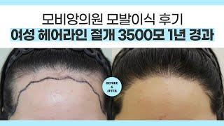   대구여성헤어라인교정 절개 모발이식 3500모 1년경과 l #창원여성탈모 #경북여성탈모치료 l 압구정모비앙의원대구
