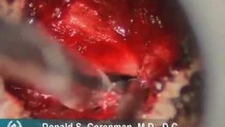 Posterior Cervical Foraminotomy | Herniated Disc Neck Surgery | Spine Surgeon Vail Denver