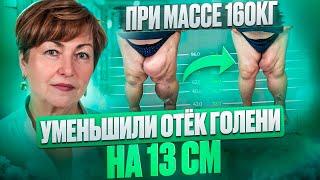 Уменьшили отек голени на 13 см. при массе тела 160 кг.