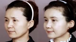 주름성형, 동안성형, 팔자주름 압구정서울성형외과