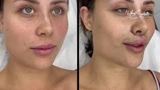 LIP LIFT SURGERY BEFORE - AFTER / OP. DR. YÜCEL SARIALTIN