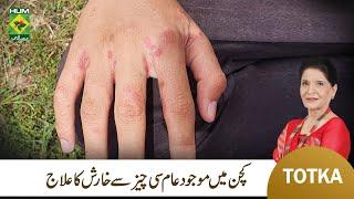 Zubaida Apa Totka | Kharish Khatam Karney ka Gharelu Ilaj | Scabies Infection Treatment | MasalaTv