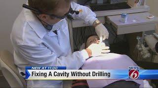 Fixing a cavity with no dental drilling