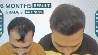 Hair Transplant in Bhopal | Best Cost & Result in Bhopal