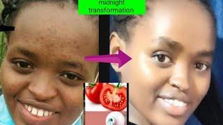 Tomato + colgate to remove pimples //  how to remove blackspots and acne / how to smoothen your skin