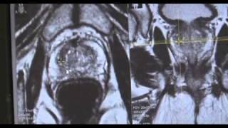Targeted Prostate Biopsy using MR-Ultrasound Fusion