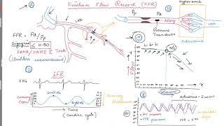 Coronary Angiogram . FFR (Fractional Flow Reserve)