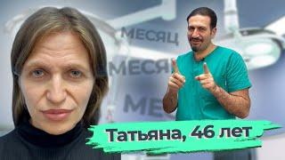 Омоложение лица,  ринопластика,  липофиллинг подбородка: Татьяна, 46 лет