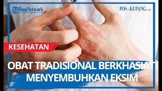 Obat Tradisional Berkhasiat Menyembuhkan Eksim