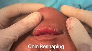 Slimming Down Your Face Permanently by Chin Reshaping Jaw Sculpting