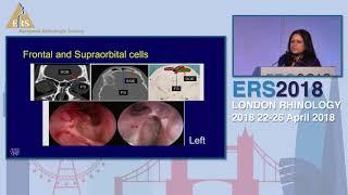 ERS London 2018, How I Do It - A Stepwise Approach To Frontal Sinus Surgery, Devyani Lal