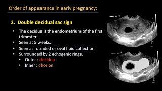 Ultrasound of normal early pregnancy