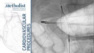 Inferior Vena Cava (IVC) Filter Placement (Eric K. Peden, MD, M. Mujeeb Zubair, MD)