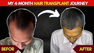 Hair Transplant 4 Months Update ‍️‍ | Real Results, Shedding Phase & Regrowth!