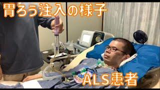 ALS患者の胃ろうの様子