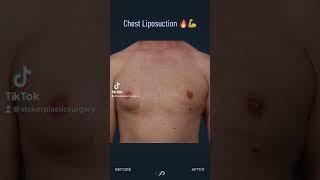 Male Chest Contouring Using Liposuction | Los Angeles, CA.