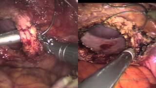 Robot-assisted laparoscopic single-site hysterectomy