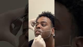 Afro Beard Transplant  | Beard Transplant in Turkey  #beardtransplant