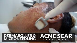 Microneedling for Acne Scars Treatment | Dermaroller Before and After | Skin Resurfacing | Dr. Jason