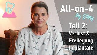 All-on-4 #2- Meine Geschichte: Verlust & Freilegung Implantate - Never2Late