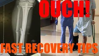 How to Recover Quickly From Broken Leg (Fractured Tibia + Fibula, ORIF Surgery)