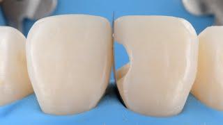 SHAPE | Proximal Matrix for anterior composite reconstruction