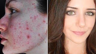 How To Cover Acne & Scars (IF You Want To) | Easy Makeup Transformation Routine