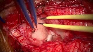 Midline suboccipital craniotomy and direct stimulation for a dorsally exophytic brainstem tumor