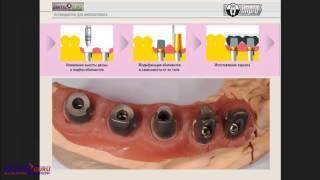 2017 06 27  Особенности выбора абатмента.  Цементная фиксация vs Винтовая.