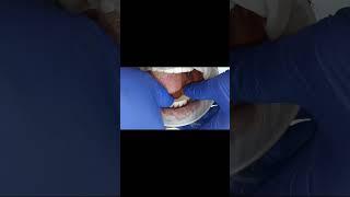 Fixed full set of new teeth with dental implants in 5 days with cutting edge technology in India!