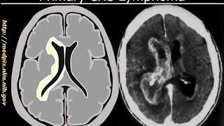 Primary CNS (Brain) Lymphoma