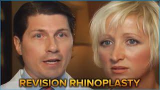 Dr Jay Calvert Revision Rhinoplasty