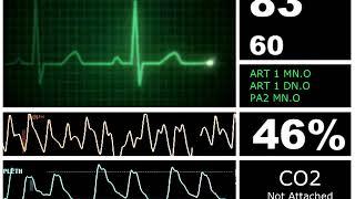 Hospital Monitor with FlatLine (M) (SD)