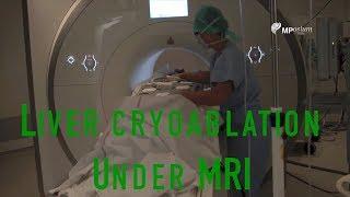 Liver cryoablation under MRI guidance