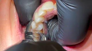 Premolar's Extraction For Orthodontic treatment