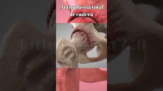 Artroplastia total de cadera#shorts #short #shortvideo #anatomy #anatomía #cadera #protesis #hueso