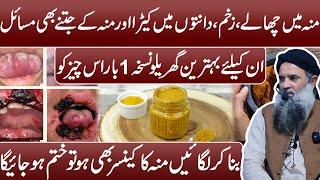 Mouth Ulcer Ka ilaj | Muh Ke Chalo Ka ilaj | Mouth Ulcer Treatment at Home in Urdu Dr Sharafat Ali