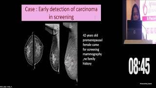 Dr Pratiksha Yadav | Advanced MRI and Mammography techniques in early detection