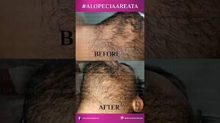 Alopecia Areata Treatment | Hair Transplant Journey | Dr Rashmi Aderao Clinic