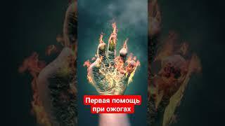 Первая помощь при термических ожогах. First aid for burns.