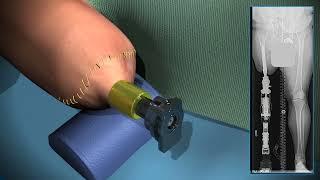 Dr. Rozbruch explains Osseointegration Limb Replacement Surgery with an animation