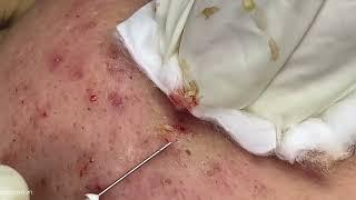 Big Cystic Acne Blackheads Extraction Blackheads & Milia, Whiteheads Removal Pimple Popping